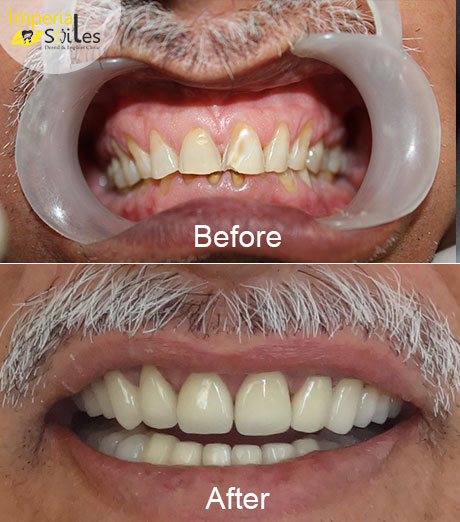 Smile Makeover Cost in Gurgaon