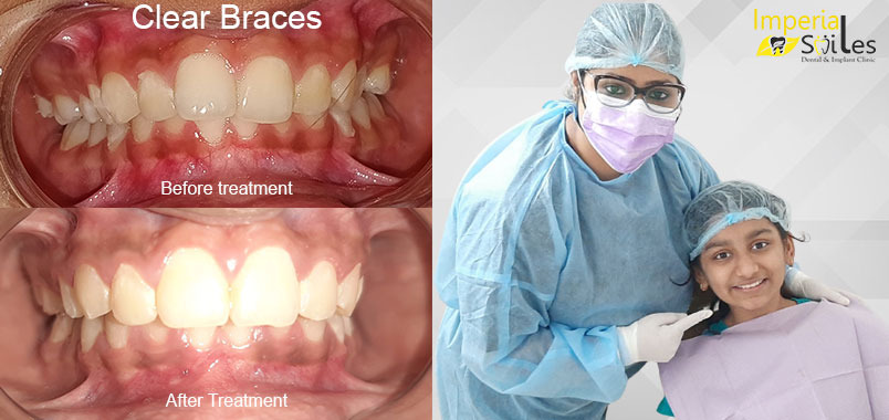 invisible braces treatment in Gurgaon