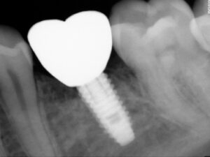 Top Dental implant clinic in Gurgaon