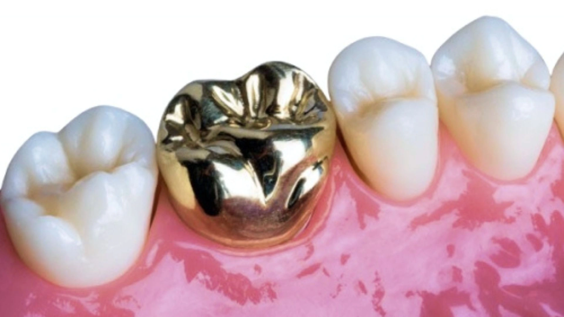 Dental Implant Clinic in Gurgaon