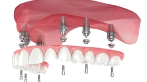 Implant supported dentures