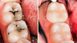 Tooth Enamel and Prevent Cavities