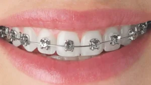 Teeth Braces