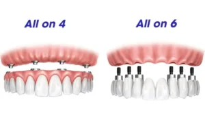All-on-4 vs All-on-6